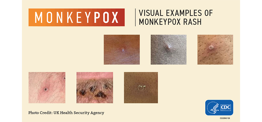Monkeypox Rash