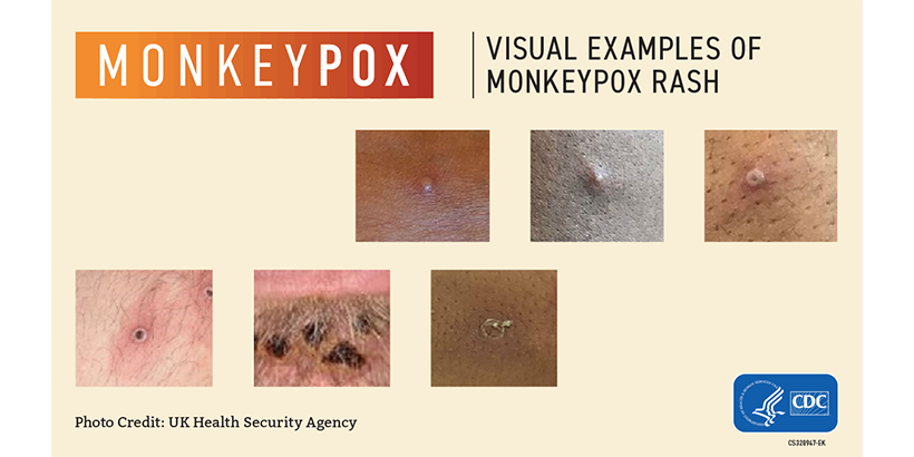Monkeypox Rash Images